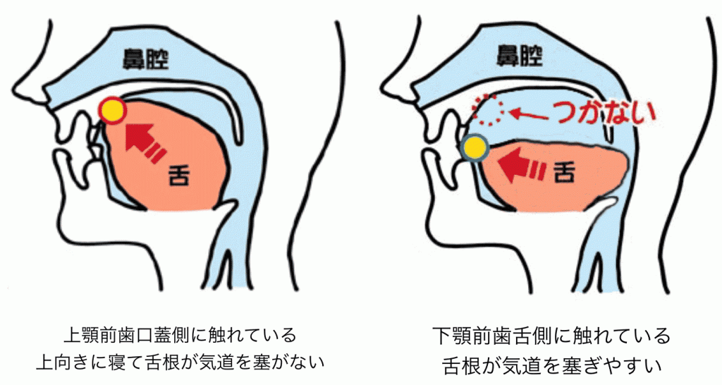舌癖と舌癖のトレーニング 子供の矯正 分割手数料0円 名古屋市栄の大山矯正歯科
